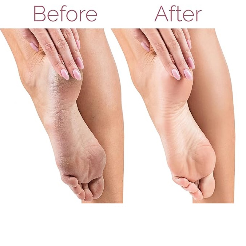 Râpe Électrique Rechargeable Pour Pieds - Rose 2 ra pe electrique rechargeable pour pieds rose e